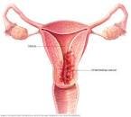 Image result for endometrial cancer
