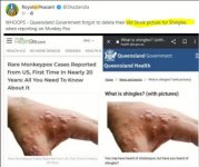shingles.JPG