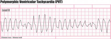 polymorphic-ventricular-tachycardia.jpg